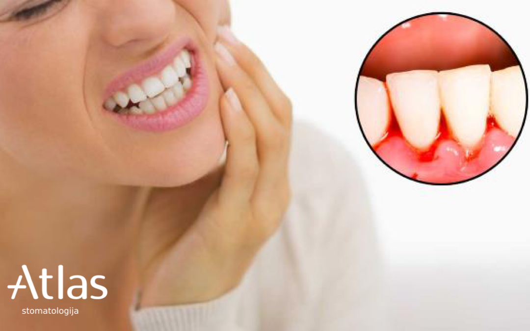 Šta znači krvarenje desni kada perete zube?